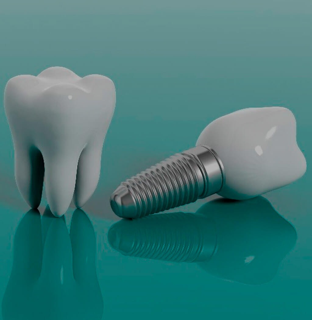 Implante dentário substitui os dentes perdidos