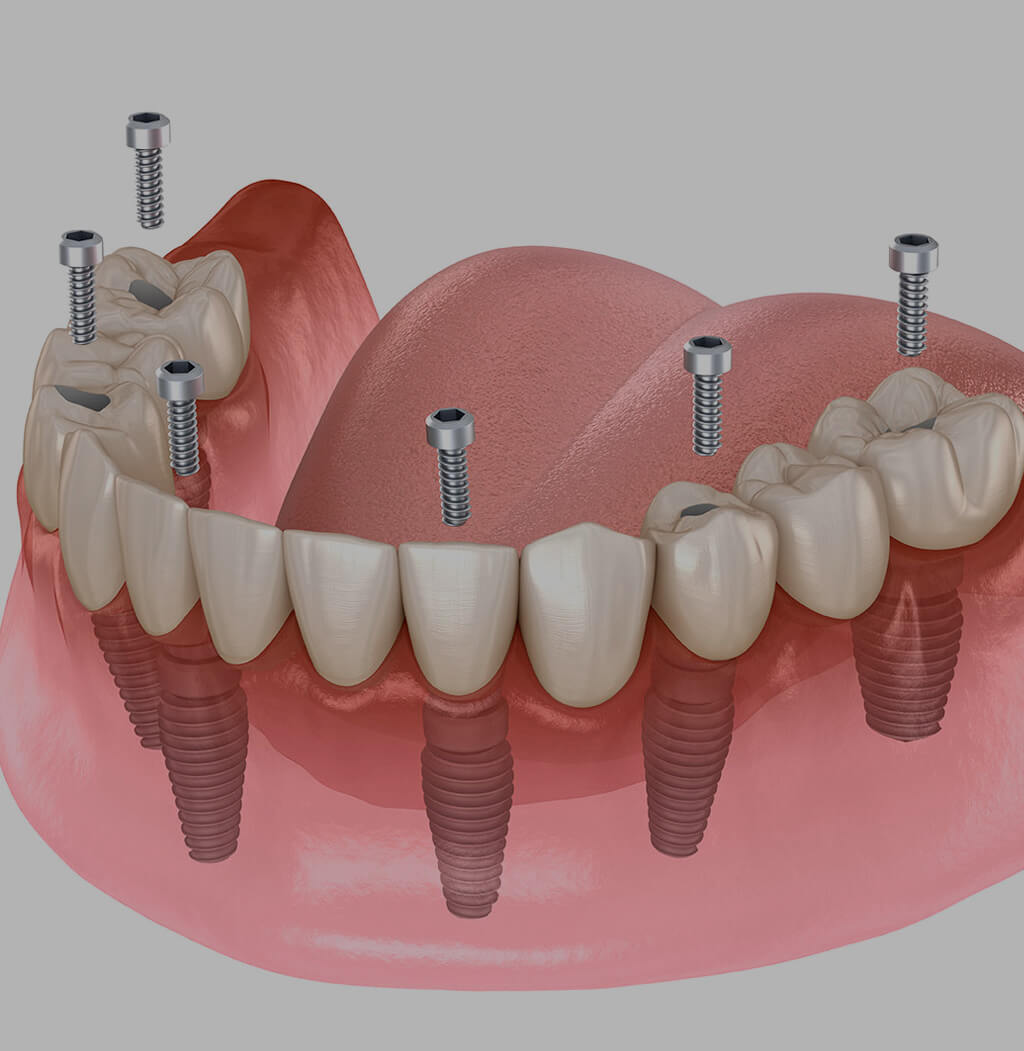 Prótese Dental tipo protocolo