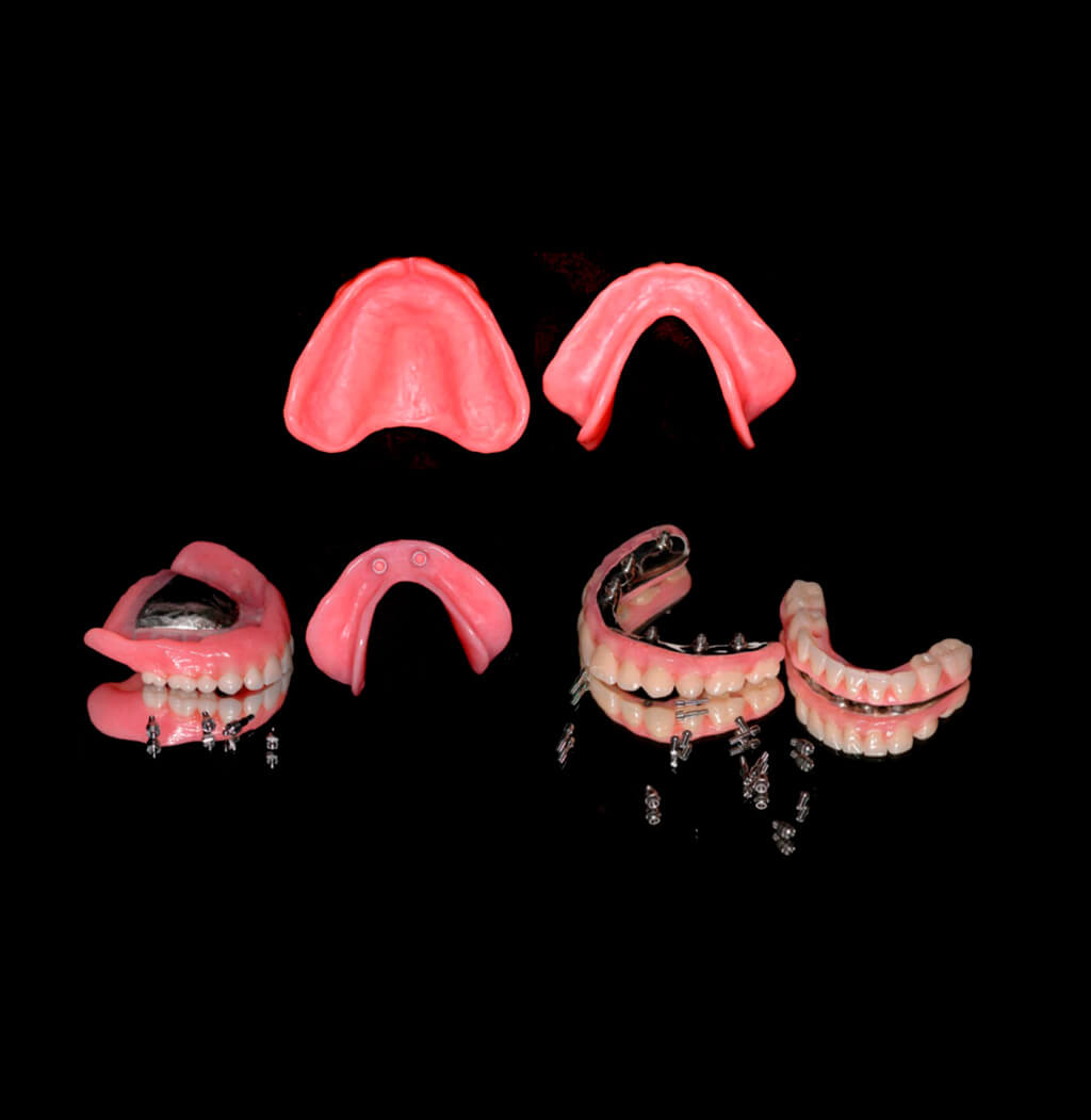 Implante dentário e prótese fixa