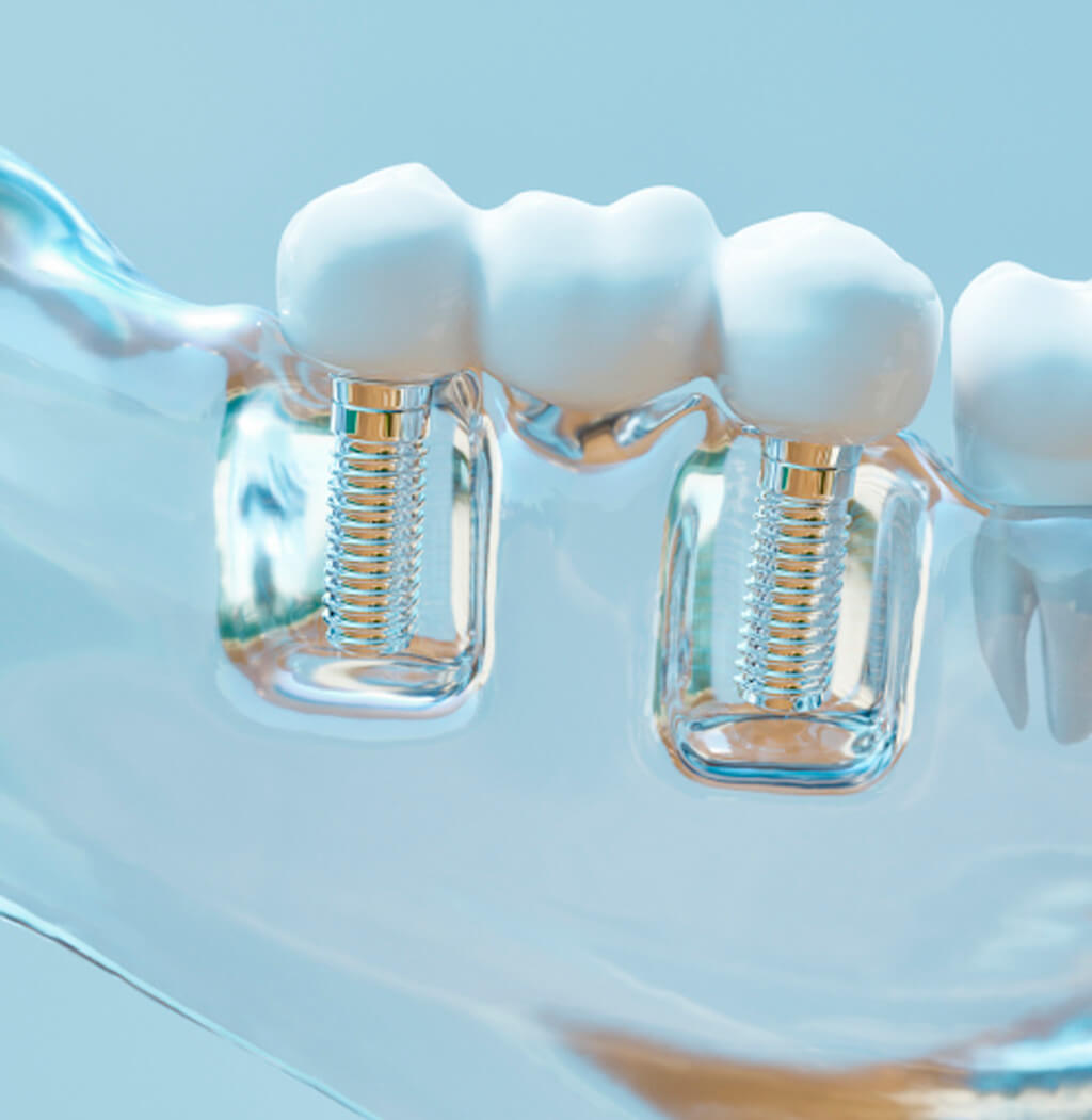 Tratamento com Implante Dentário