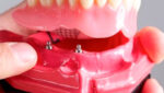 Tipos de Próteses Dentárias