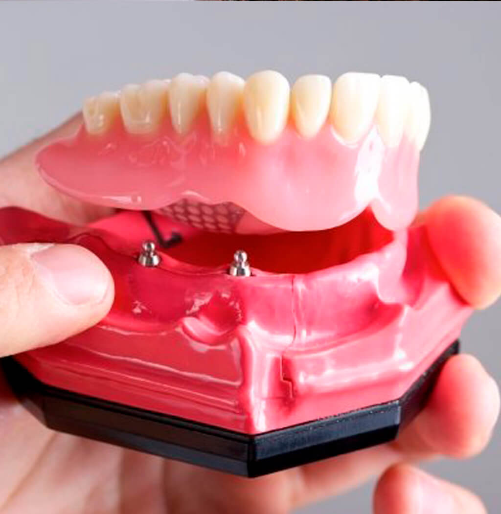 Tipos de Próteses Dentárias