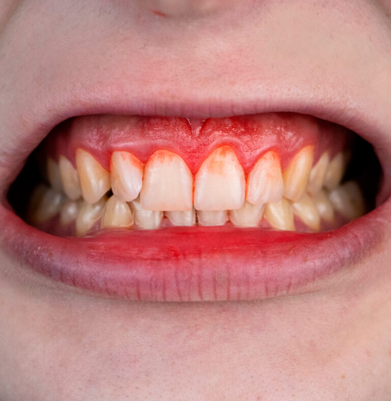 Doença Periodontal