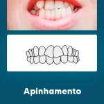 Odontologia Miofuncional Apinhamento