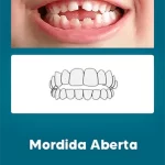 Odontologia Miofuncional Mordida Aberta