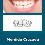 Odontologia Miofuncional Mordida Cruzada