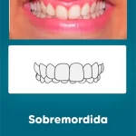 Odontologia Miofuncional Sobremordida