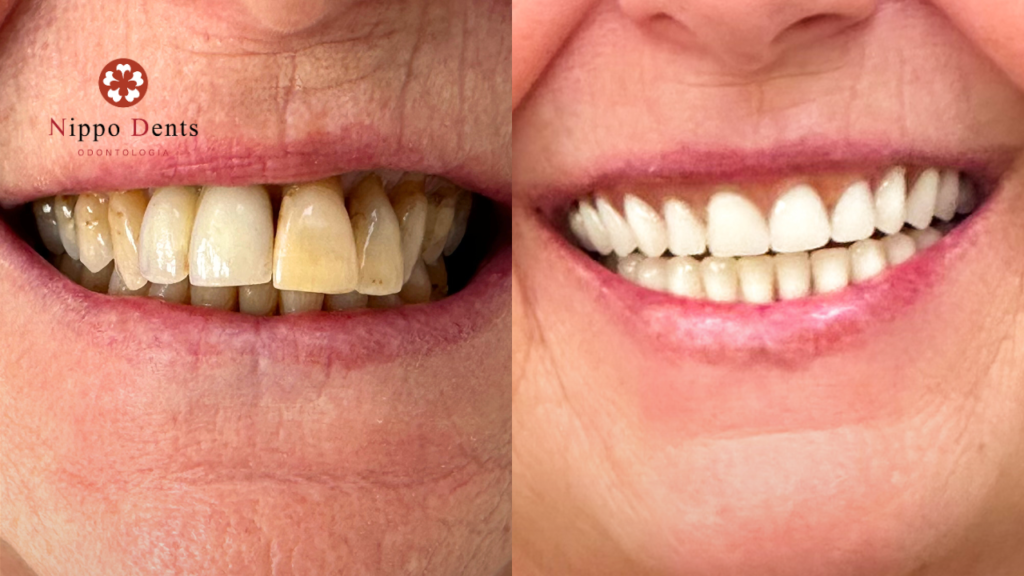 Comparação do sorriso antes e depois do tratamento com implantes dentários
