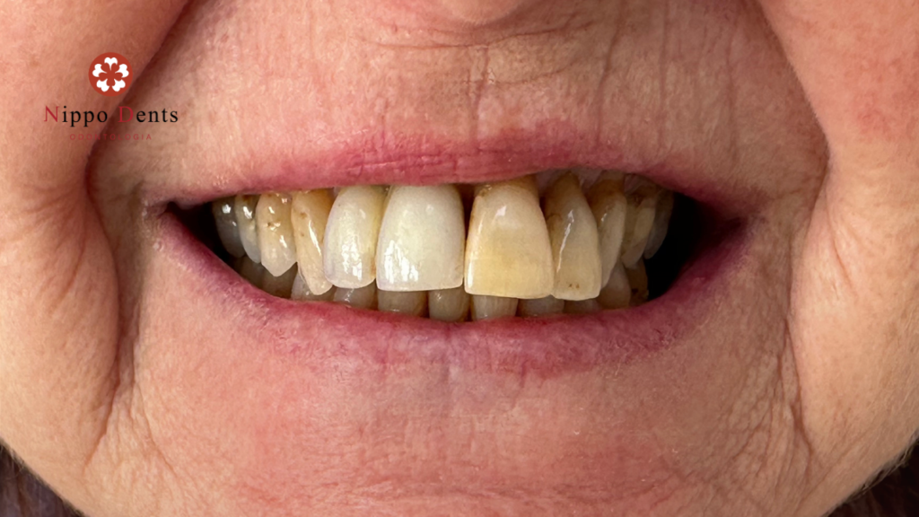 Imagem de dentes comprometidos antes do tratamento com implantes dentários

