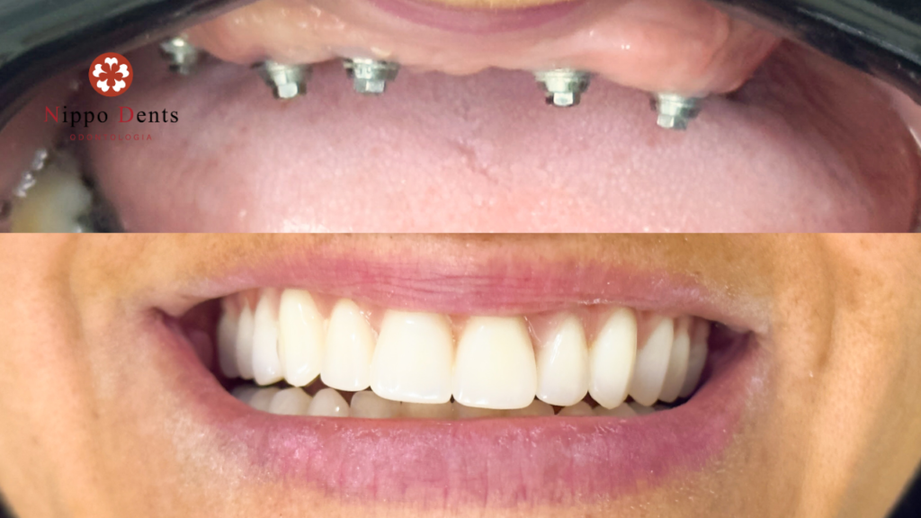 Resultado do tratamento com implantes de carga imediata, mostrando a reabilitação rápida do sorriso