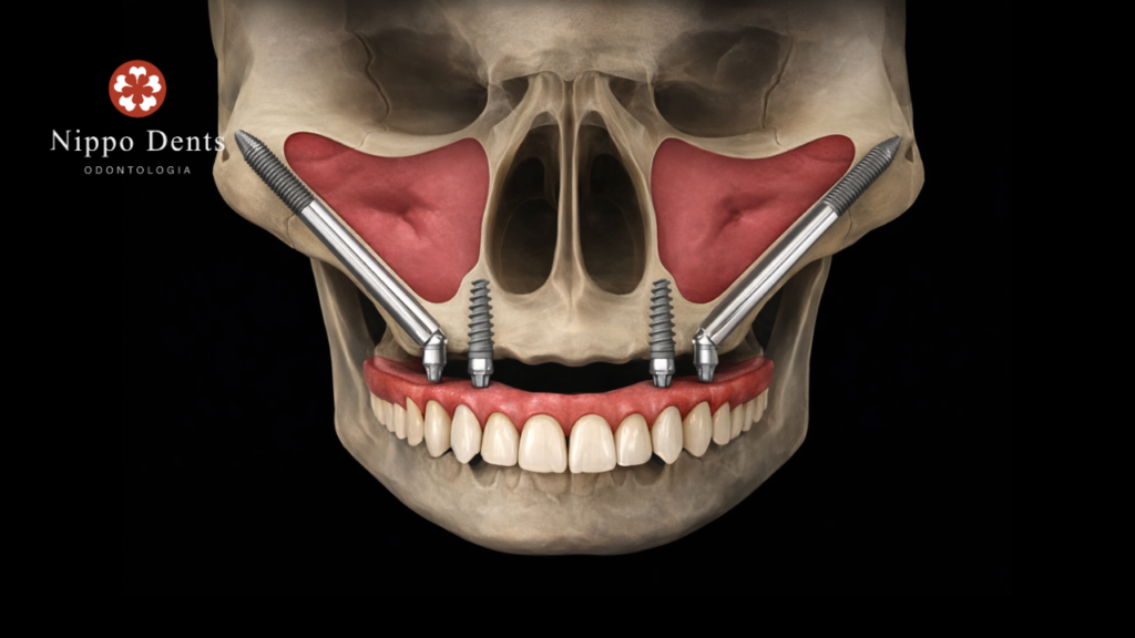 Ilustração mostrando implantes zigomáticos fixados no osso zigomático em casos de atrofia maxilar