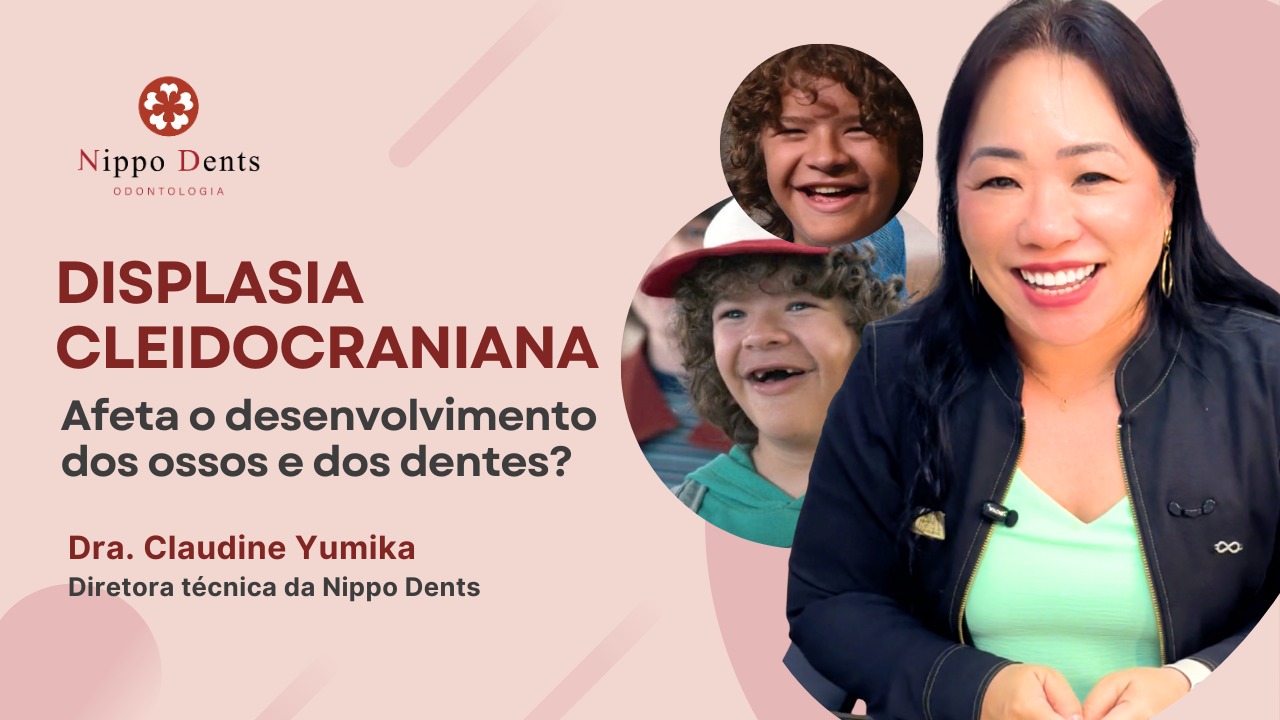 Banner informativo sobre displasia cleidocraniana mostrando alterações no desenvolvimento dos ossos e dos dentes em crianças.
