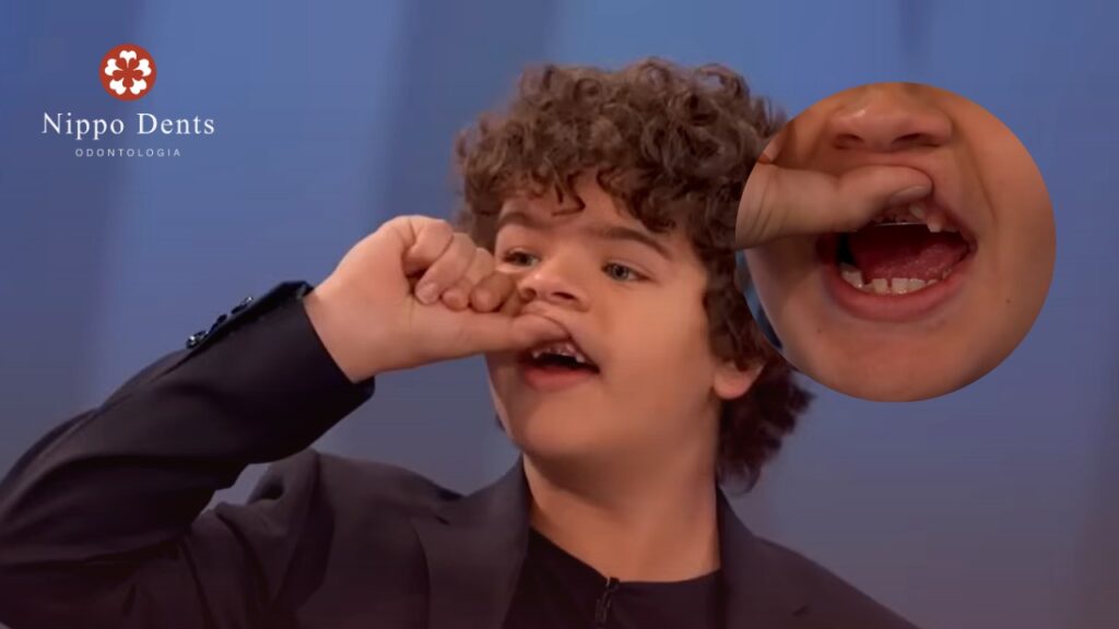 : Imagem ilustrativa mostrando alterações dentárias frequentemente associadas à displasia cleidocraniana em crianças