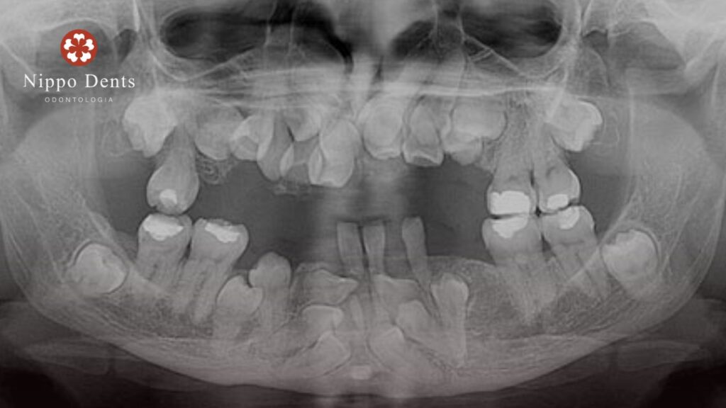 Radiografia panorâmica mostrando dentes supranumerários e atraso na erupção dentária característicos da displasia cleidocraniana