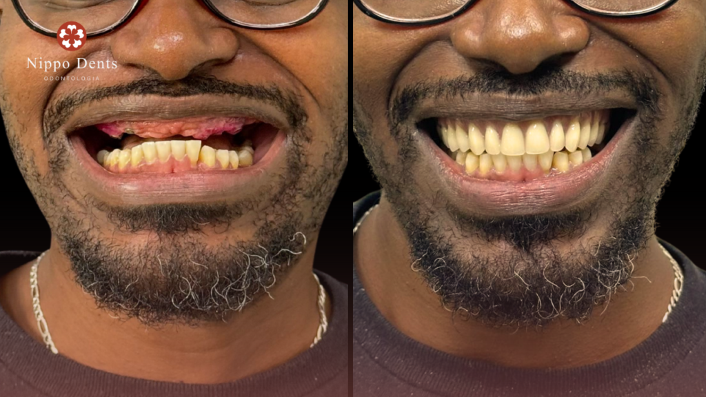 Comparação do sorriso de um paciente antes e depois de receber prótese fixa com carga imediata
