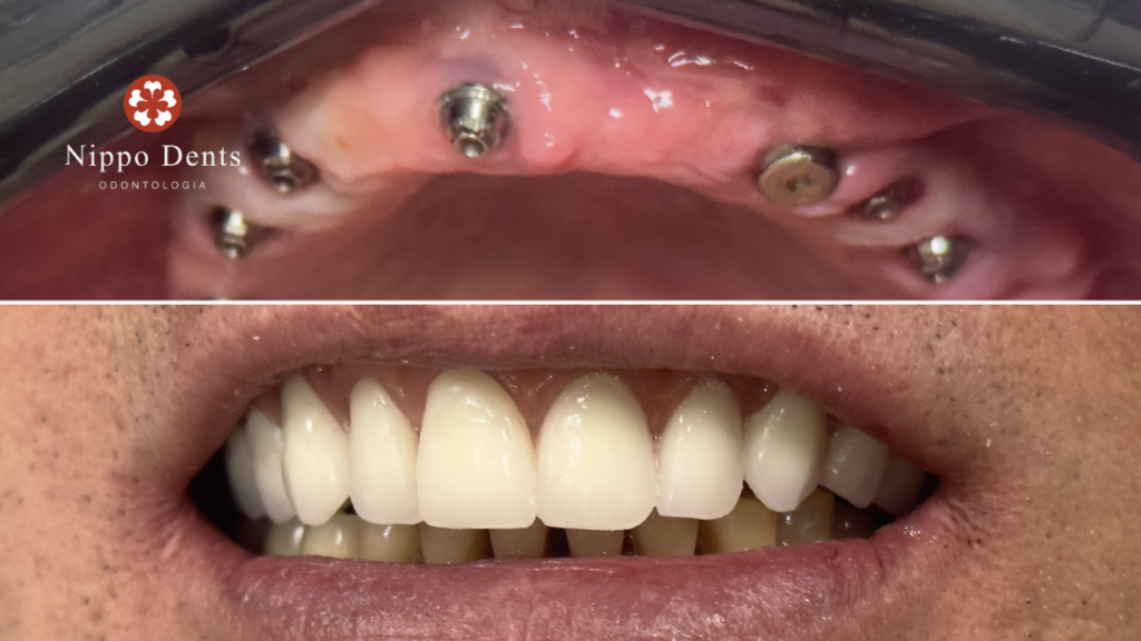 Implantes instalados na arcada superior e sorriso final após prótese fixa de carga imediata