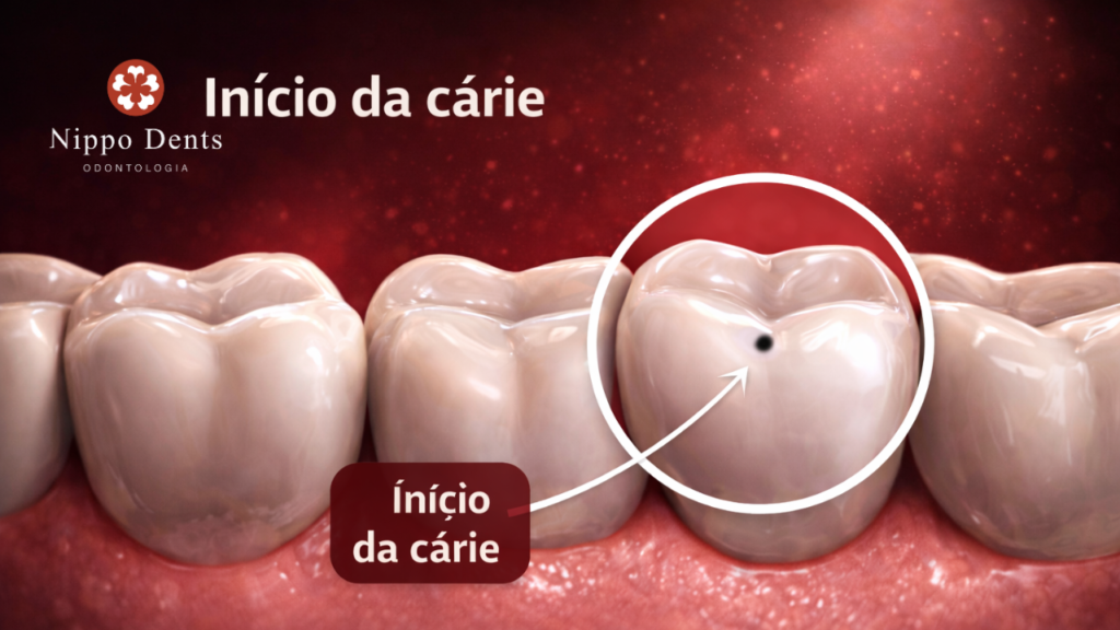 Início da cárie mostrando ponto escuro no esmalte do dente, indicando a fase inicial da doença