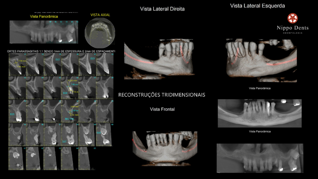 Tomografia computadorizada 3D mostrando medidas ósseas e reconstrução facial para planejamento de implantes