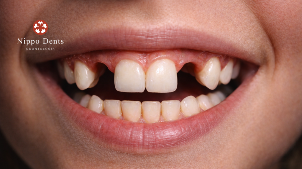 Sorriso de criança mostrando ausência de dente permanente na arcada superior, indicando atraso de erupção ou agenesia