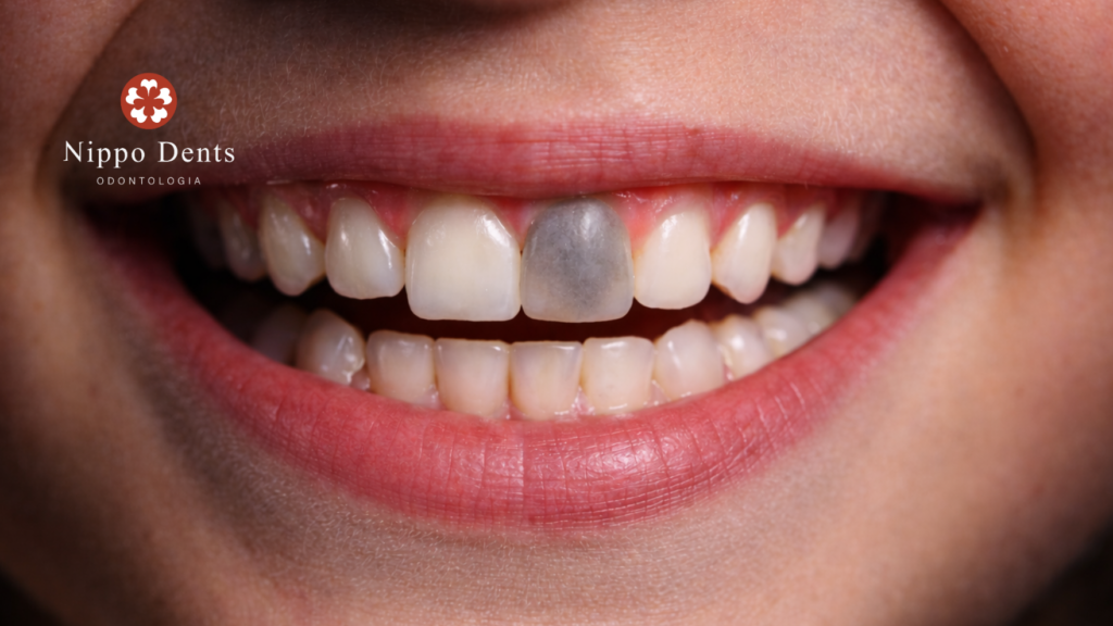 Dente escurecido na região anterior devido a trauma, mostrando alteração de cor em comparação aos demais dentes