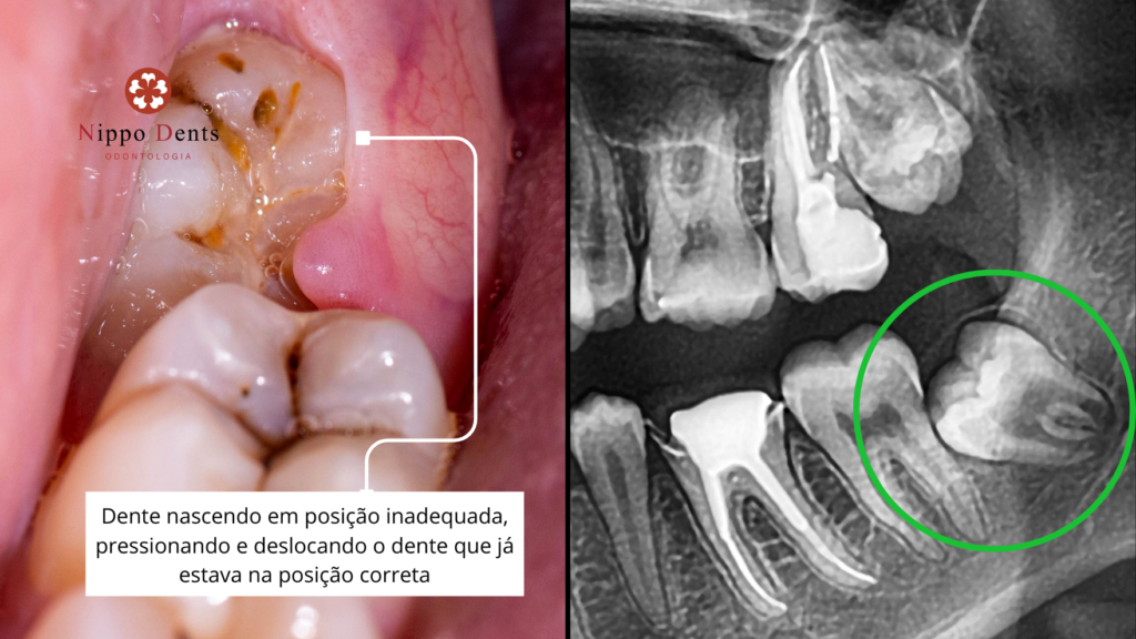 Dente permanente nascendo atrás do dente de leite, mostrando dupla linha de dentes e necessidade de avaliação odontológica