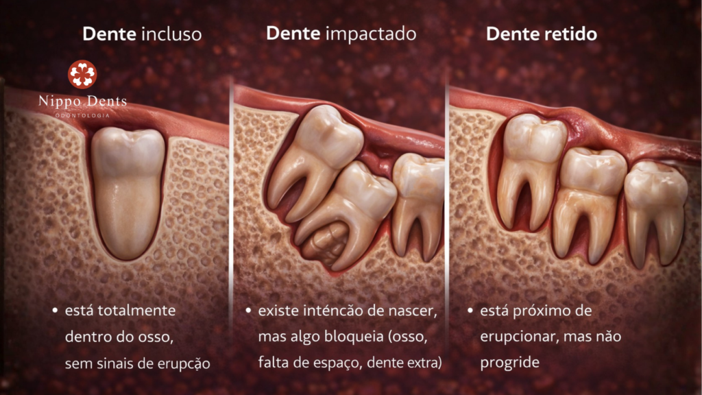 Ilustração comparativa mostrando dente incluso dentro do osso, dente impactado com bloqueio na erupção e dente retido próximo de nascer, mas sem progredir.