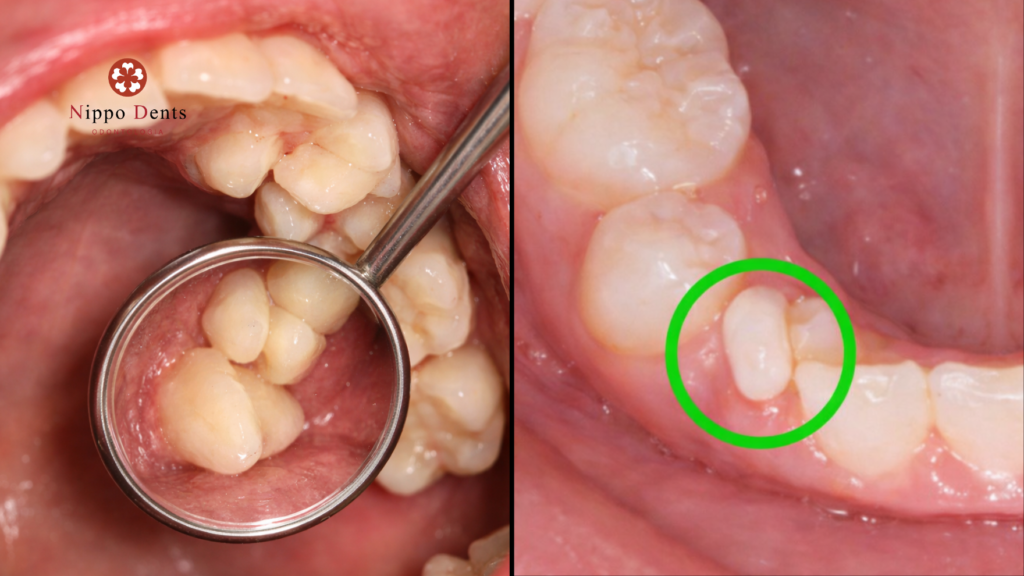 Dente permanente nascendo atrás do dente de leite, formando dupla linha de dentes e indicando atraso na troca dentária