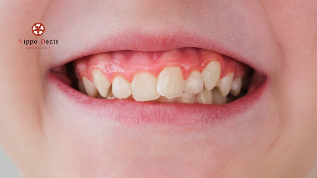 Dentes permanentes nascendo tortos em criança, mostrando desalinhamento e gengiva inflamada na fase de troca dentária