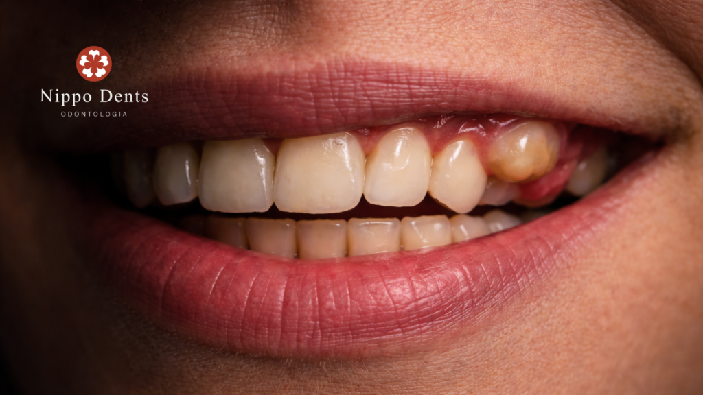 Infecção gengival com dente incluso causando inchaço, vermelhidão e dor na região anterior superior