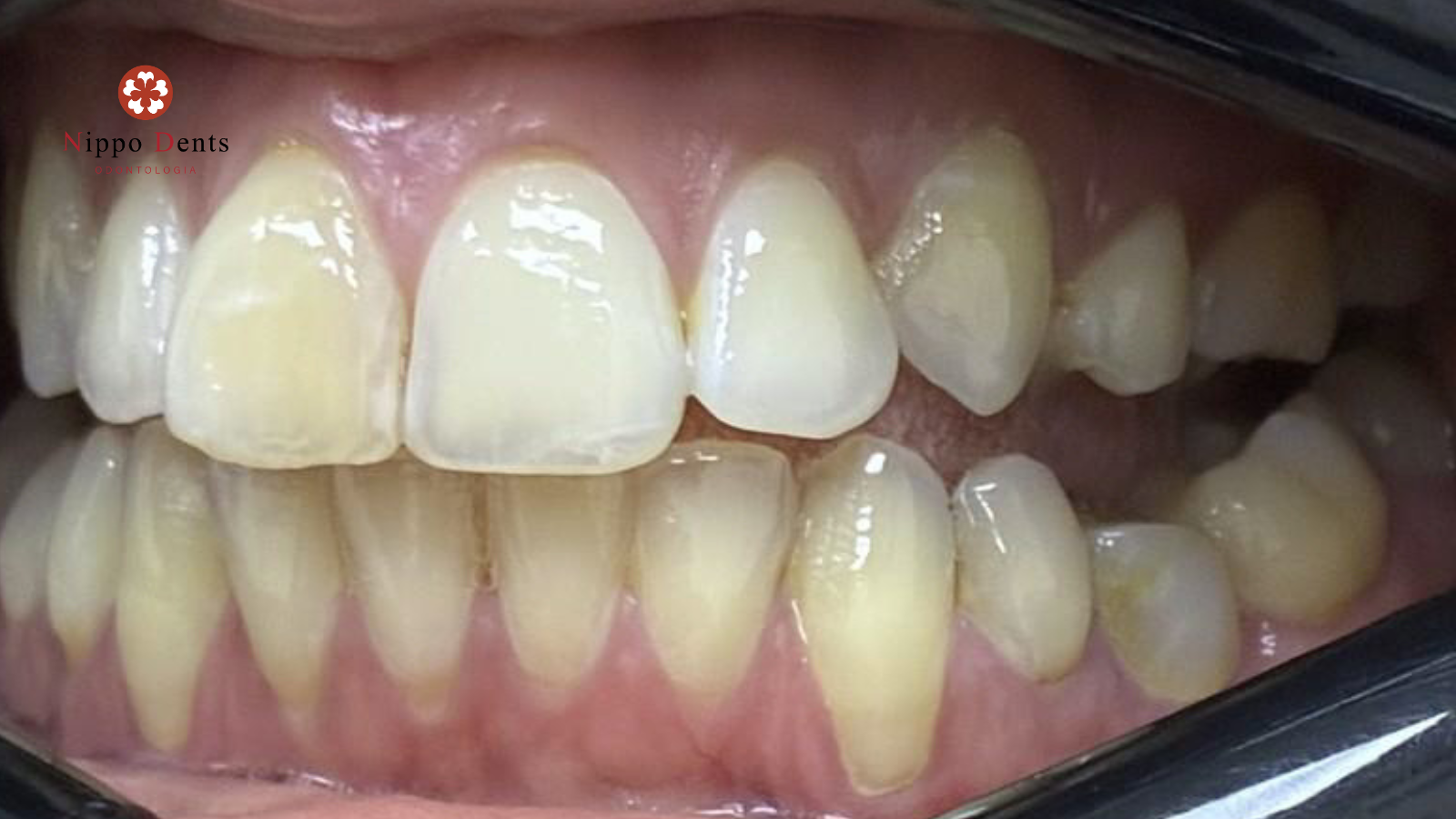 Imagem clínica mostrando desgaste dental causado por bruxismo com dentes gastos, bordas planas e perda de estrutura