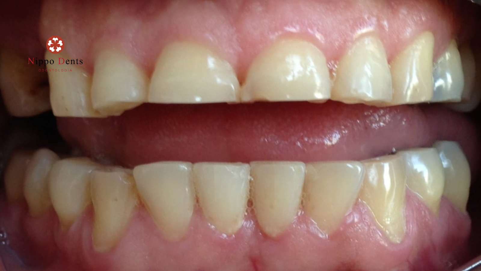 Dentes desgastados por bruxismo mostrando achatamento dental e perda de estrutura