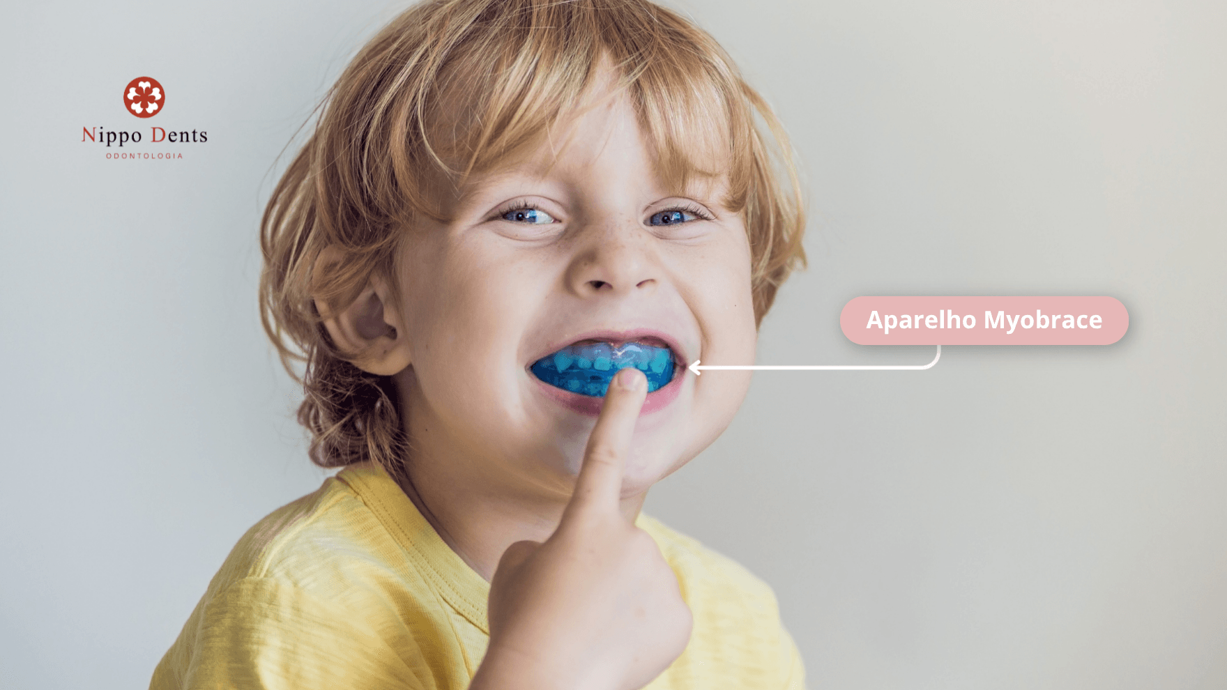 Aparelho Myobrace infantil usado no tratamento de bruxismo infantil e correção funcional