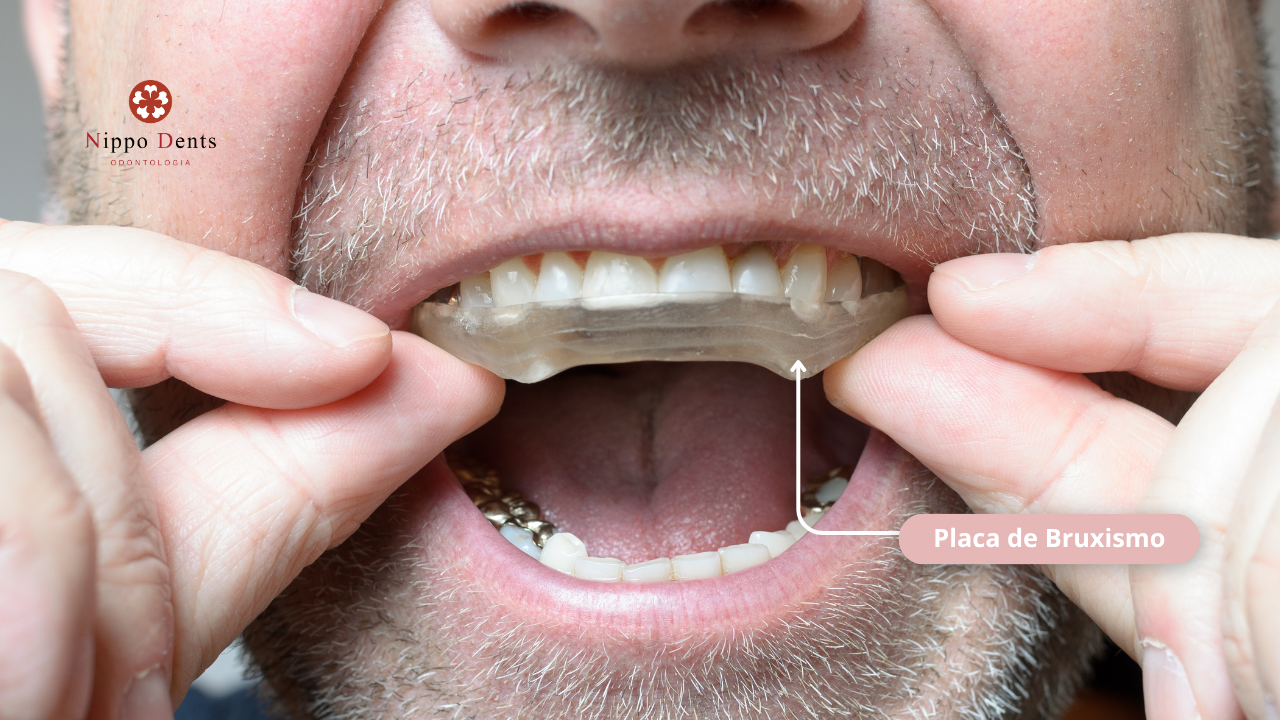Placa oclusal sob medida usada para proteger dentes contra desgaste causado pelo bruxismo