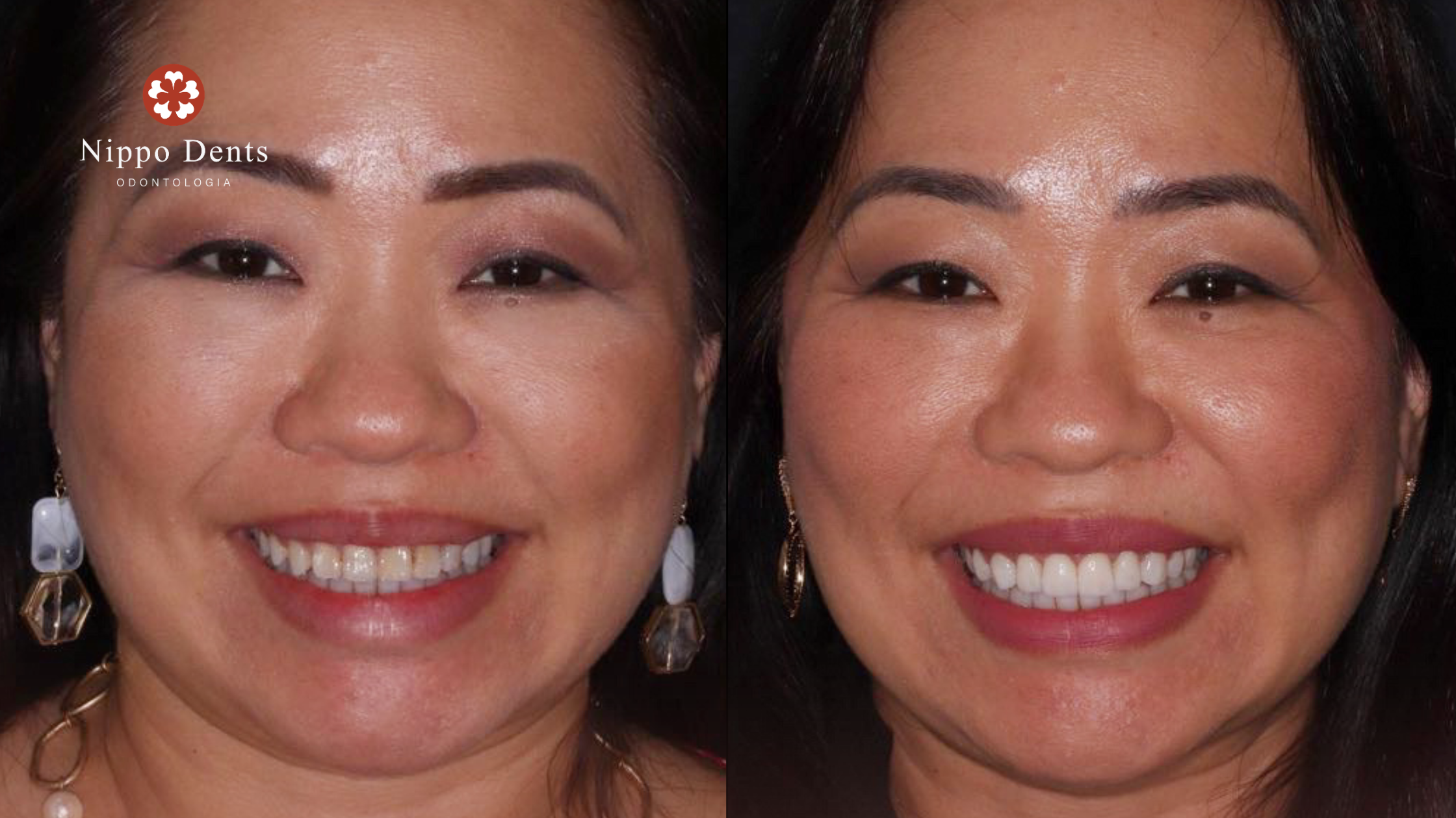 Comparação de sorriso antes e depois do tratamento com lente de contato dental realizado na Nippo Dents Odontologia.