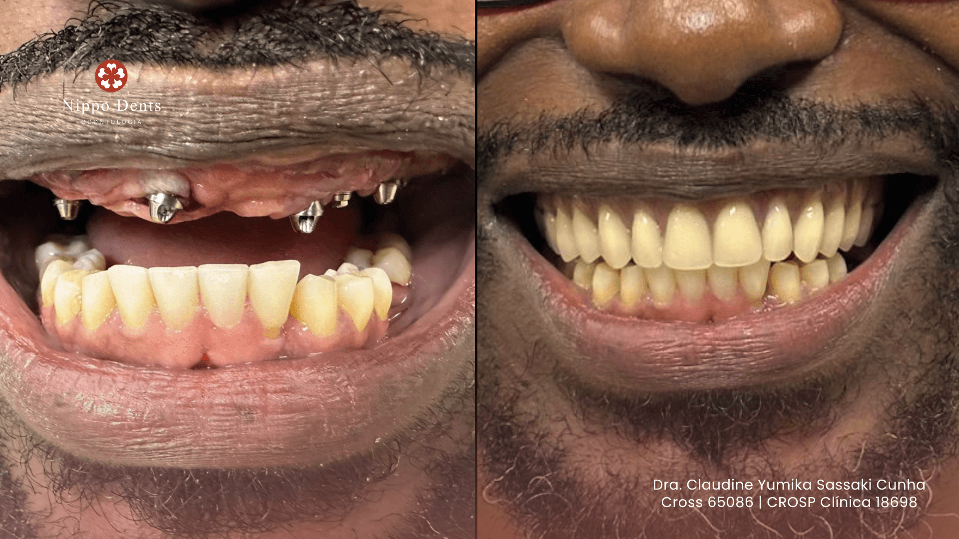 Resultado antes e depois de prótese protocolo fixa sobre implantes em paciente da Nippo Dents Odontologia