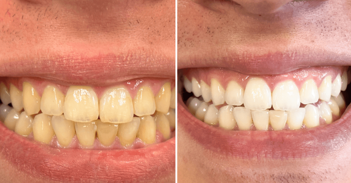 Clareamento dental em São Judas