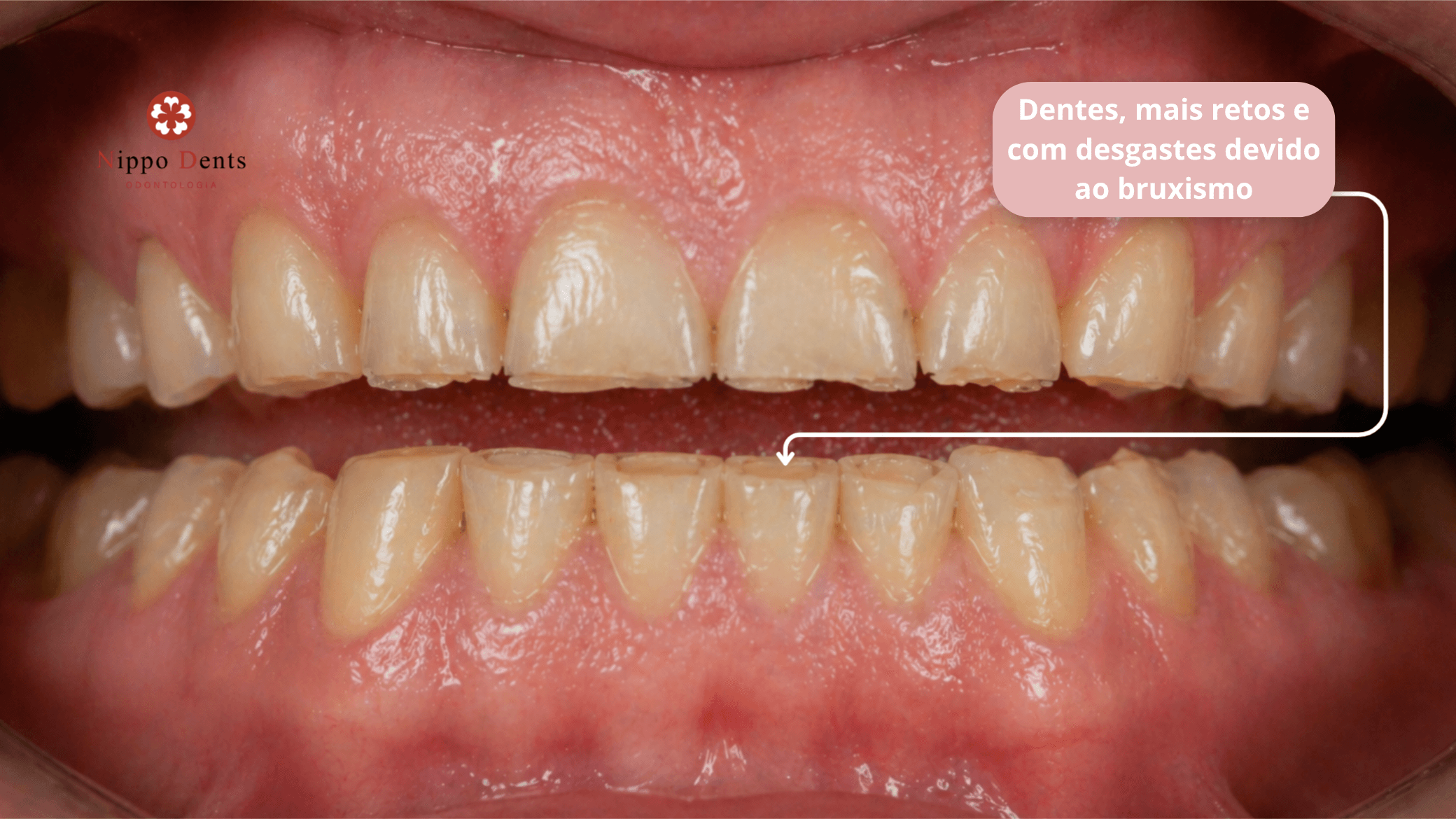 Desgaste nos dentes anteriores provocado pelo bruxismo e apertamento dental.