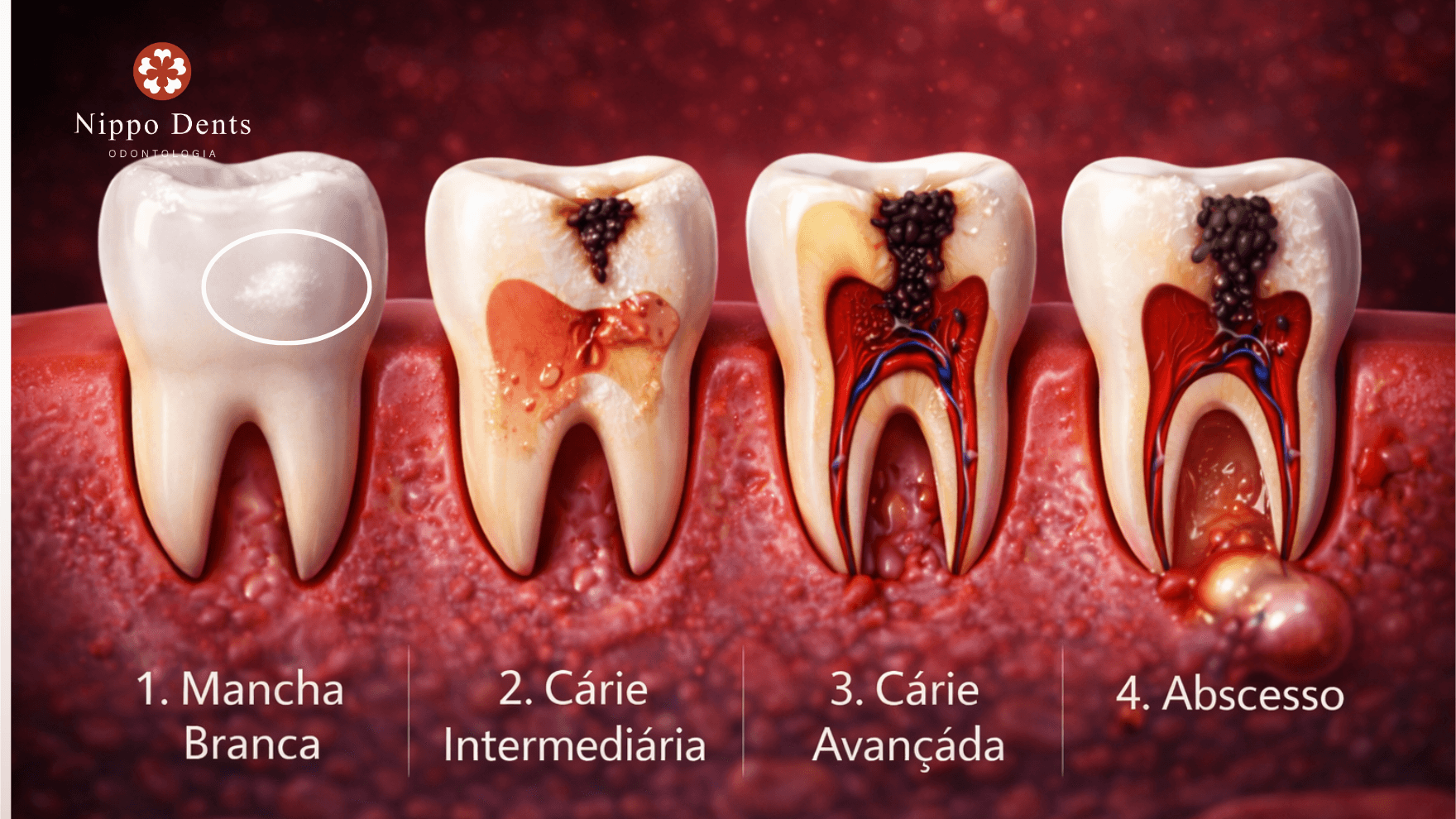 Ilustração mostrando os estágios da evolução da cárie dentária até abscesso