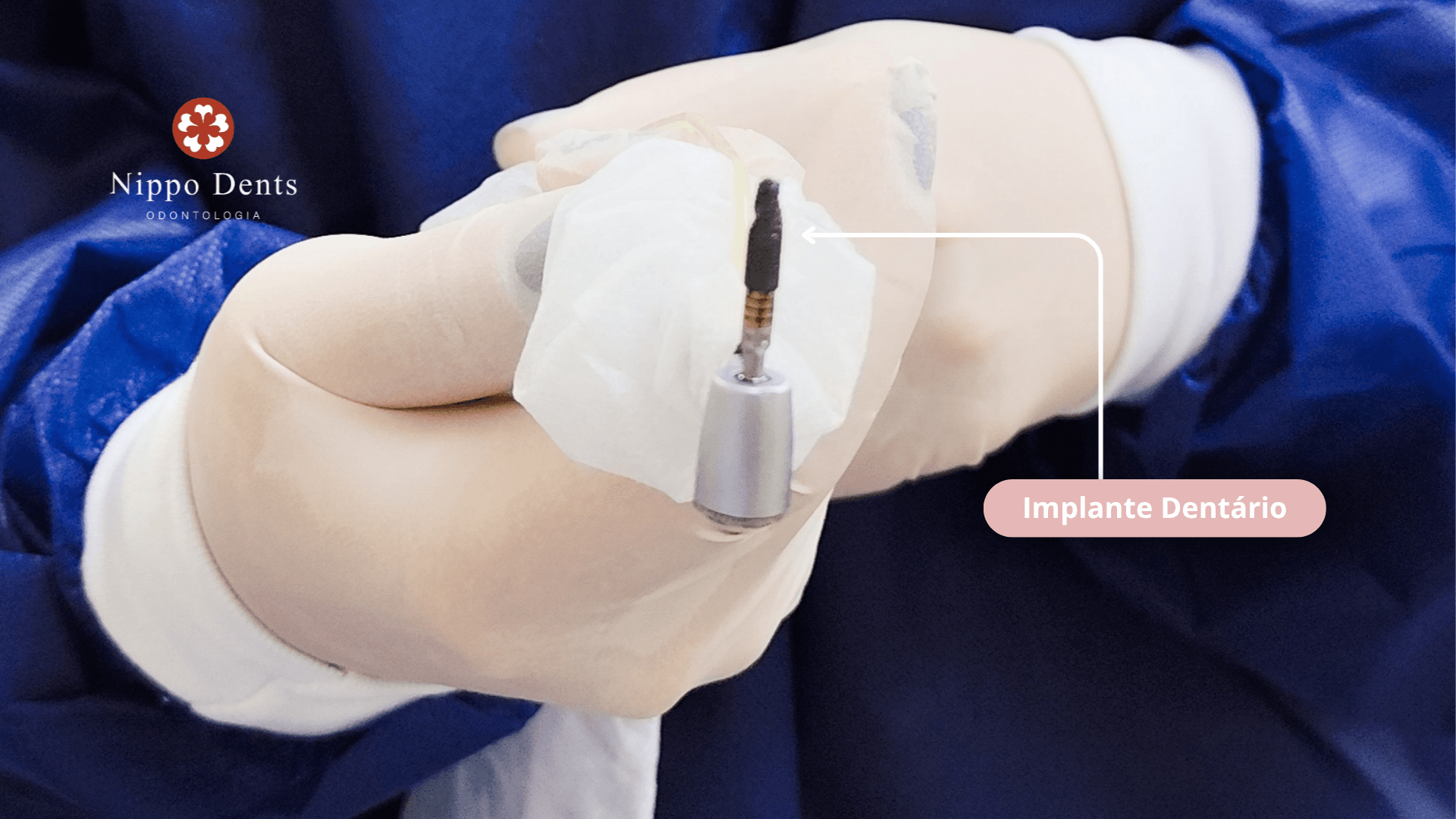 Implante dentário sendo apresentado durante procedimento cirúrgico na Nippo Dents Odontologia