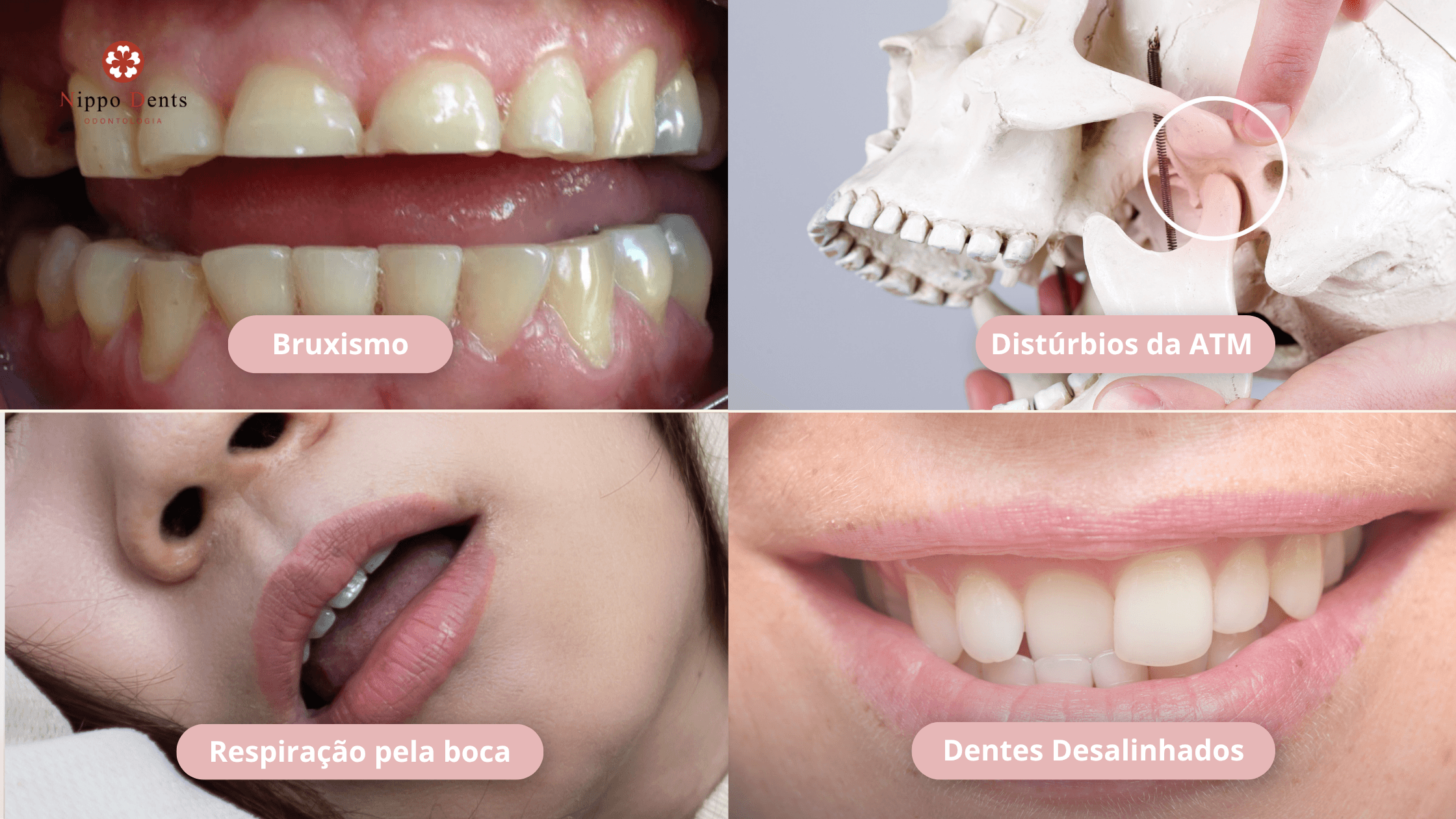 Ilustração apresentando indicações do tratamento miofuncional como bruxismo, distúrbios da ATM, respiração bucal e desalinhamento dental.