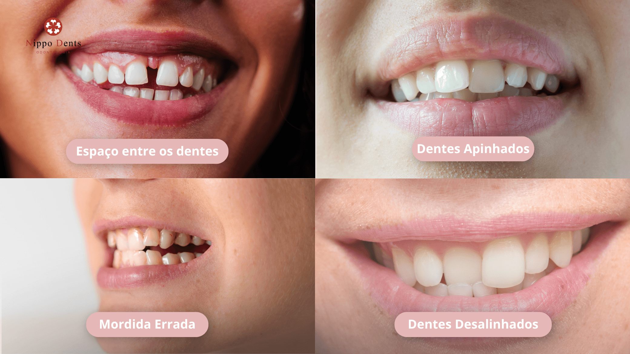 Exemplos de dentes desalinhados, apinhados, mordida incorreta e espaços entre dentes tratados com alinhadores transparentes.
