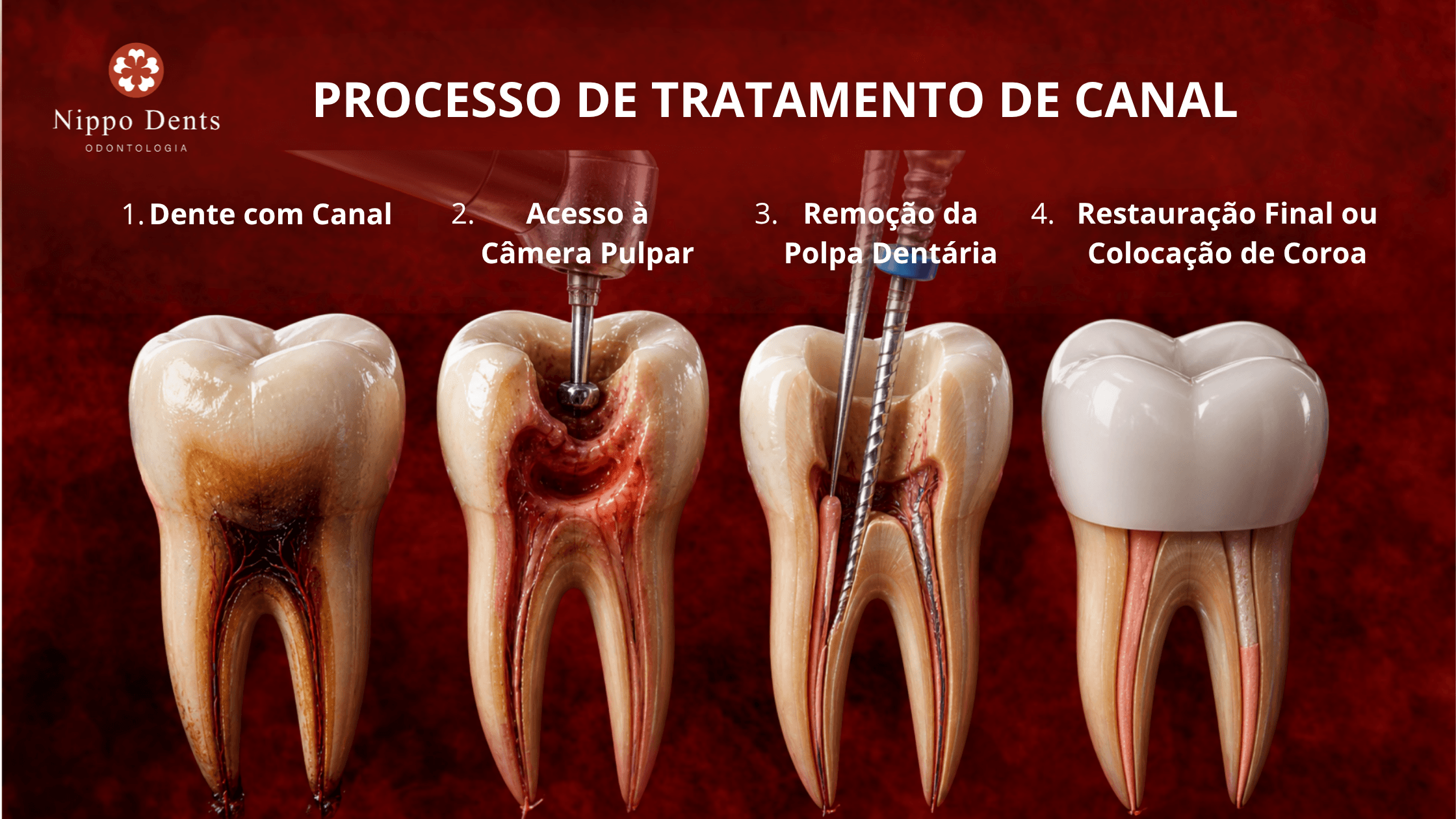 Ilustração demonstrando as etapas do tratamento de canal desde a remoção da infecção até a restauração do dente.