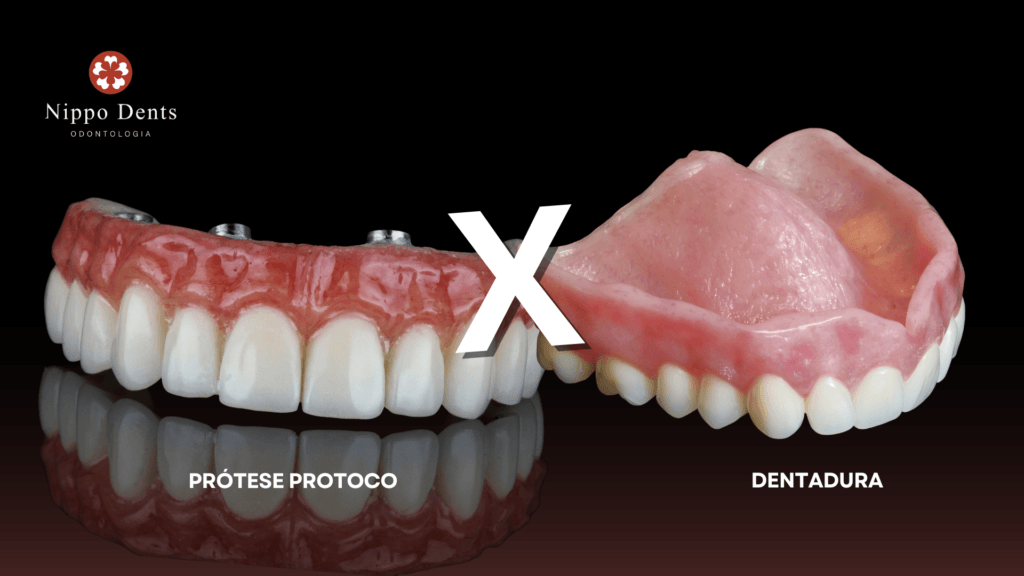 Comparação entre prótese protocolo fixa sobre implantes e dentadura removível tradicional