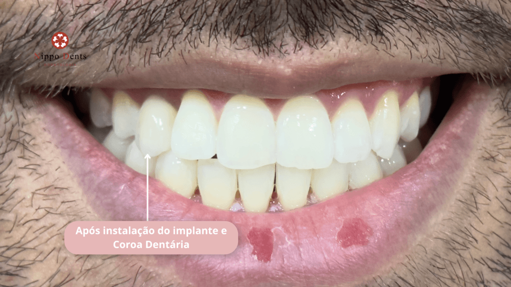 Resultado estético após instalação de implante dentário e coroa dentária em paciente da Nippo Dents