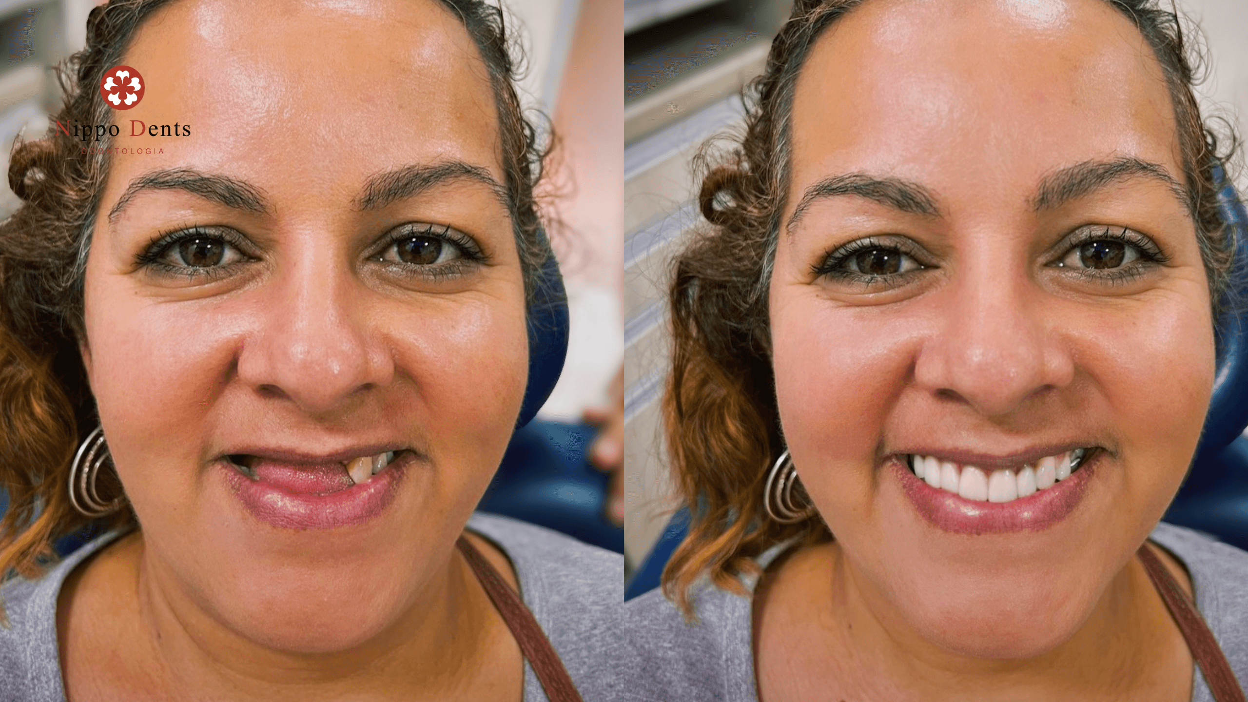 Paciente em tratamento de reabilitação oral recuperando estética e função do sorriso
