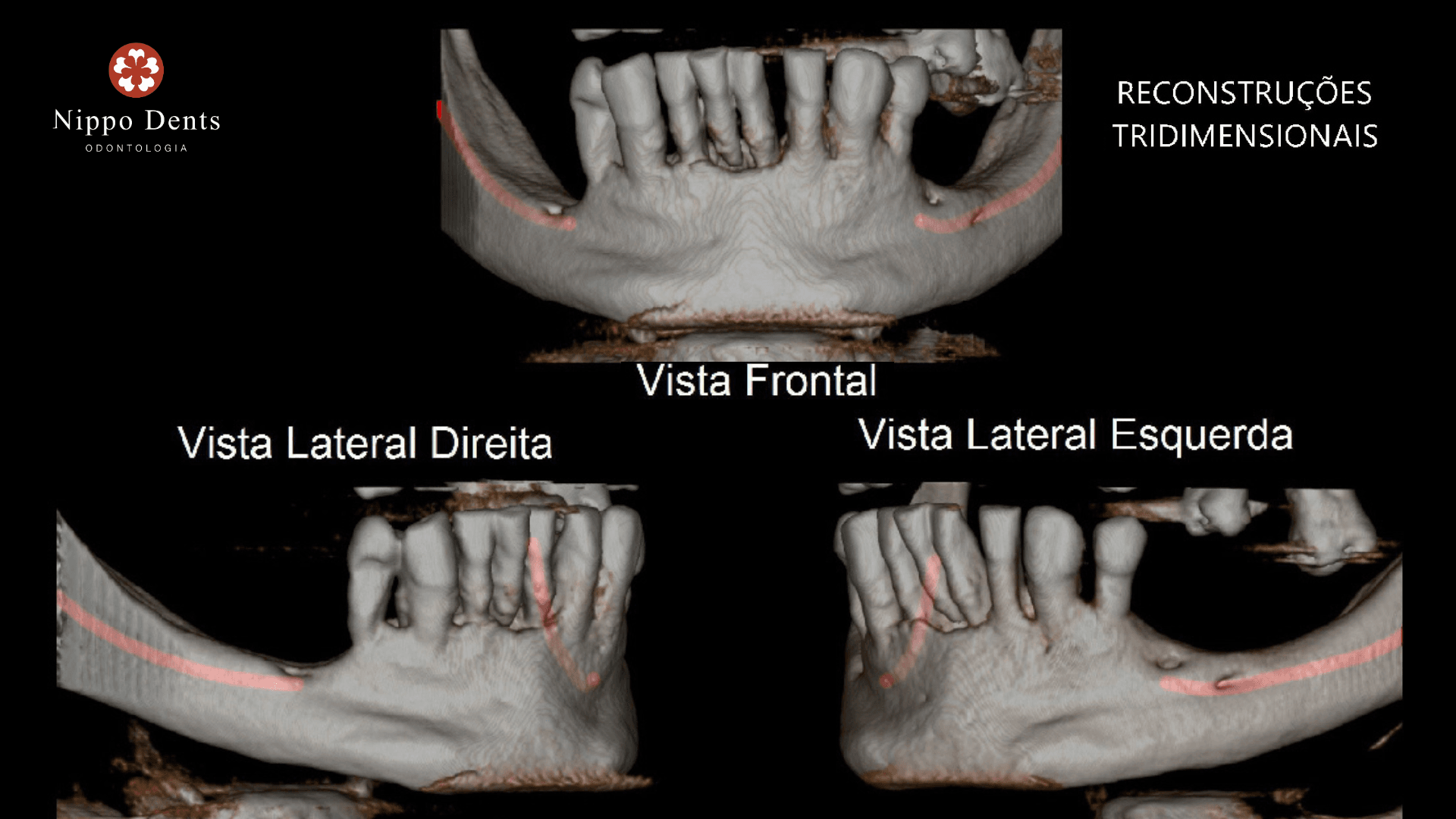 Tomografia odontológica utilizada no planejamento digital para carga imediata e implante dentário