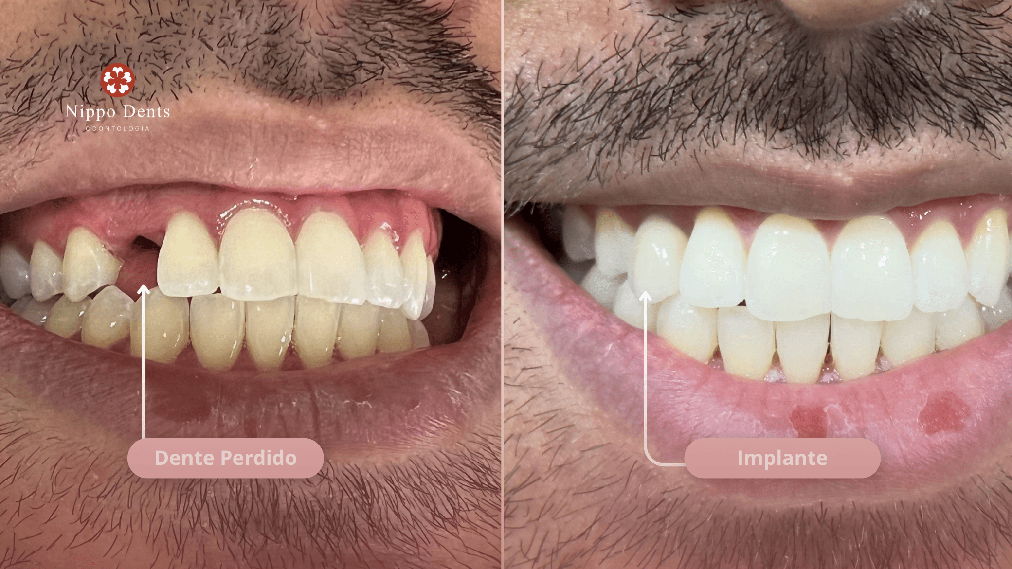 Procedimento odontológico relacionado à reabilitação oral funcional e estética